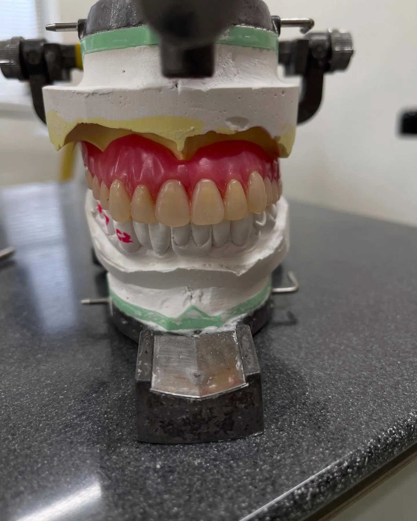 上あごの総入れ歯（総義歯）は、多くの方にとって飲食時に違和感...