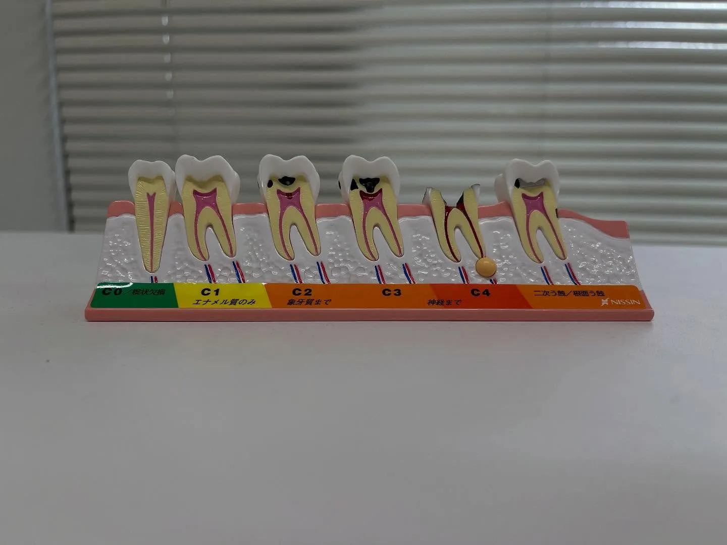 新たに虫歯の進行具合をリアルに示すことができる模型を入手いた...