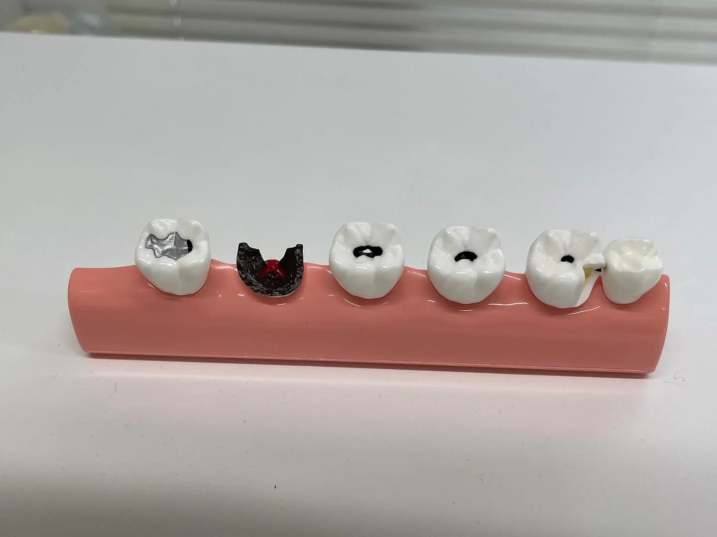 新たに虫歯の進行具合をリアルに示すことができる模型を入手いた...