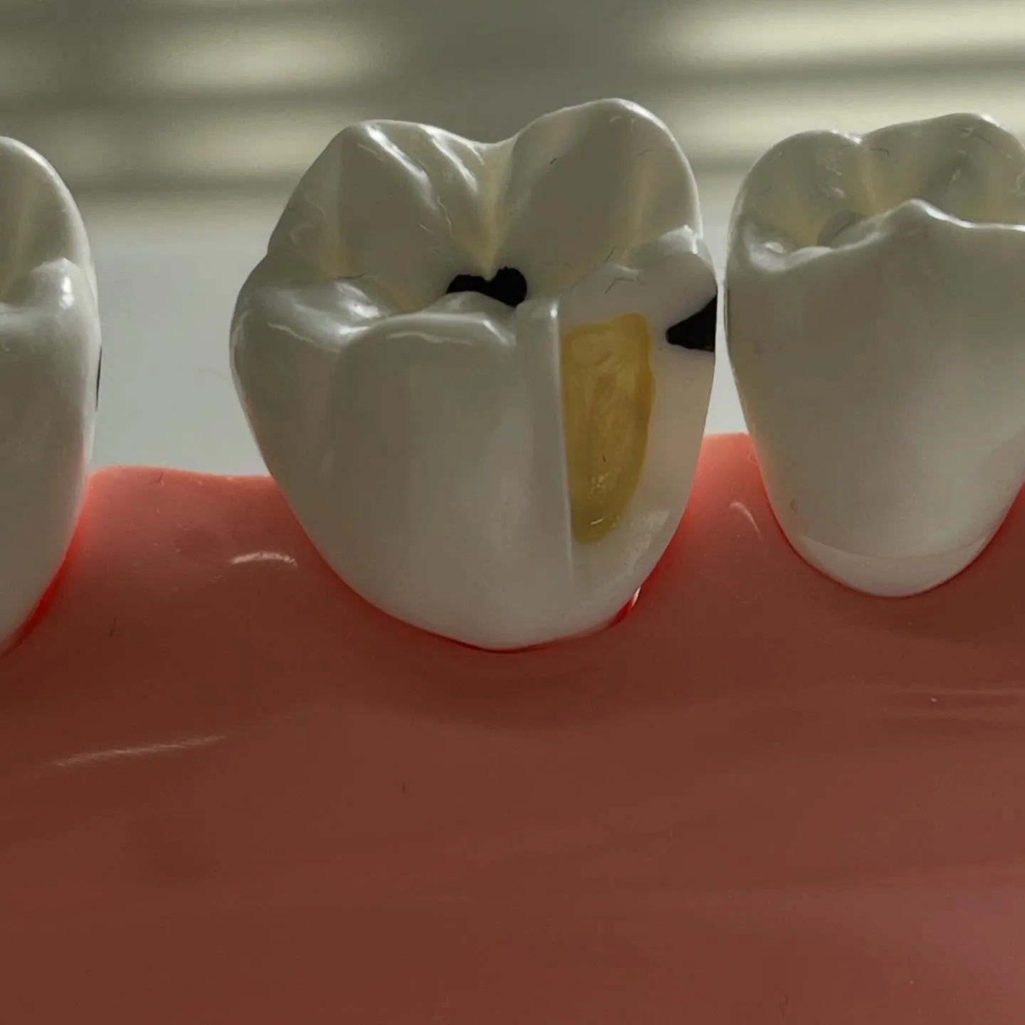 虫歯が出来た途端に痛みを感じるわけではありません。