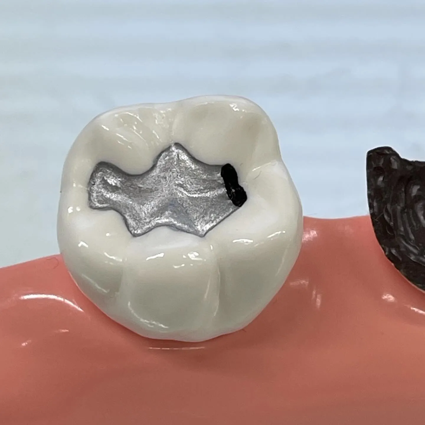 あなたの歯の健康を守るためには、虫歯の治療だけでなく、その後...