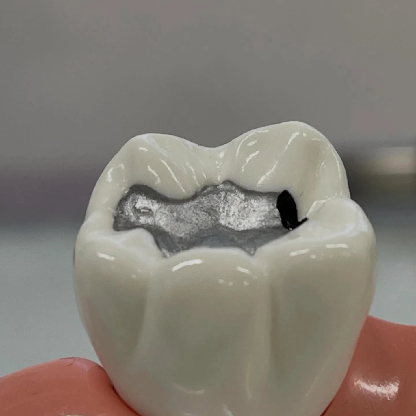 あなたの歯の健康を守るためには、虫歯の治療だけでなく、その後...